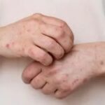 Confirman primer fallecimiento por Mpox en Jalisco