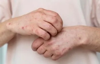 Confirman primer fallecimiento por Mpox en Jalisco