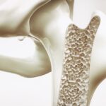 Osteoporosis, un enemigo silencioso también para los hombres