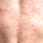 Refuerzan medidas de prevención ante brote de sarampión en Jalisco