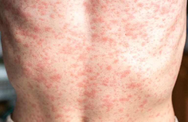 Refuerzan medidas de prevención ante brote de sarampión en Jalisco