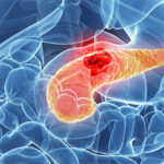 Cáncer de páncreas, rumbo a convertirse en la segunda causa de muerte por cáncer en 2030