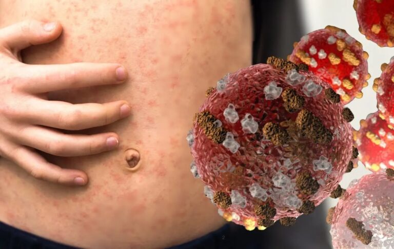 OPS llama a México y EE. UU. a evaluar su situación sanitaria ante brote de sarampión